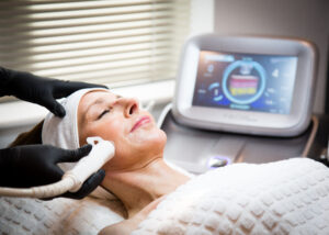 acne scarring treatment - RF microneedling