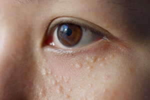 milia around the eye area