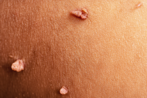 close-up of skin tag