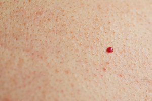 close-up of blood spot