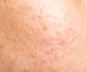 acne scarring