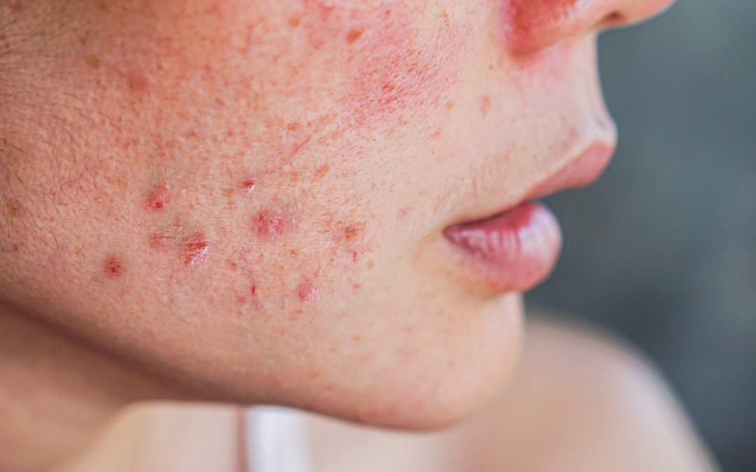 Hormonal Breakouts on the Chin: How SkinGenius Clinic Can Help