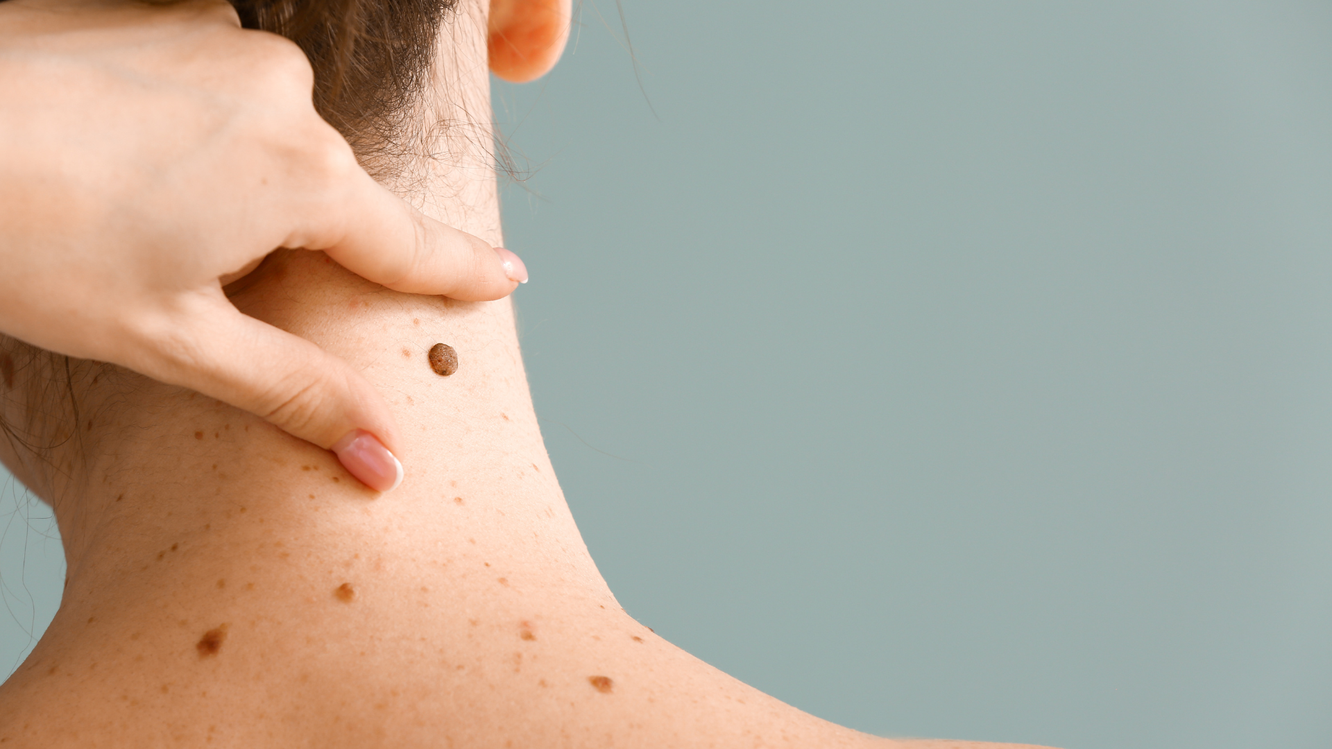 Mole or Skin Lesion image woman with moles on her back - mole or skin lesion