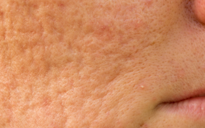 Acne Scarring | The Most Effective Treatments In 2026