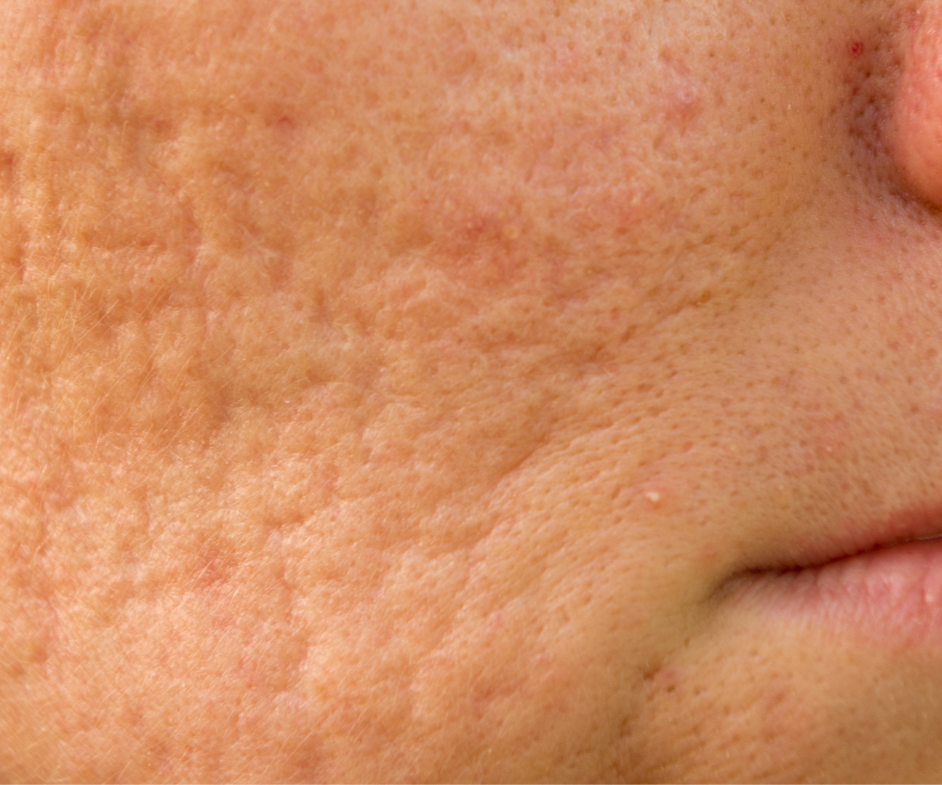 5 acne scarring close-up on cheek